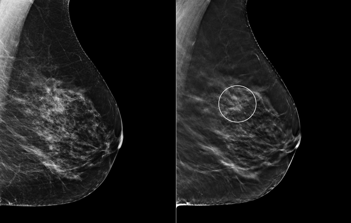 Tomosynthesis increases confidence - European Radiology